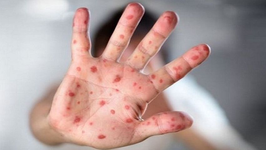 হামের উপসর্গে আরও ৬ শিশুর মৃত্যু